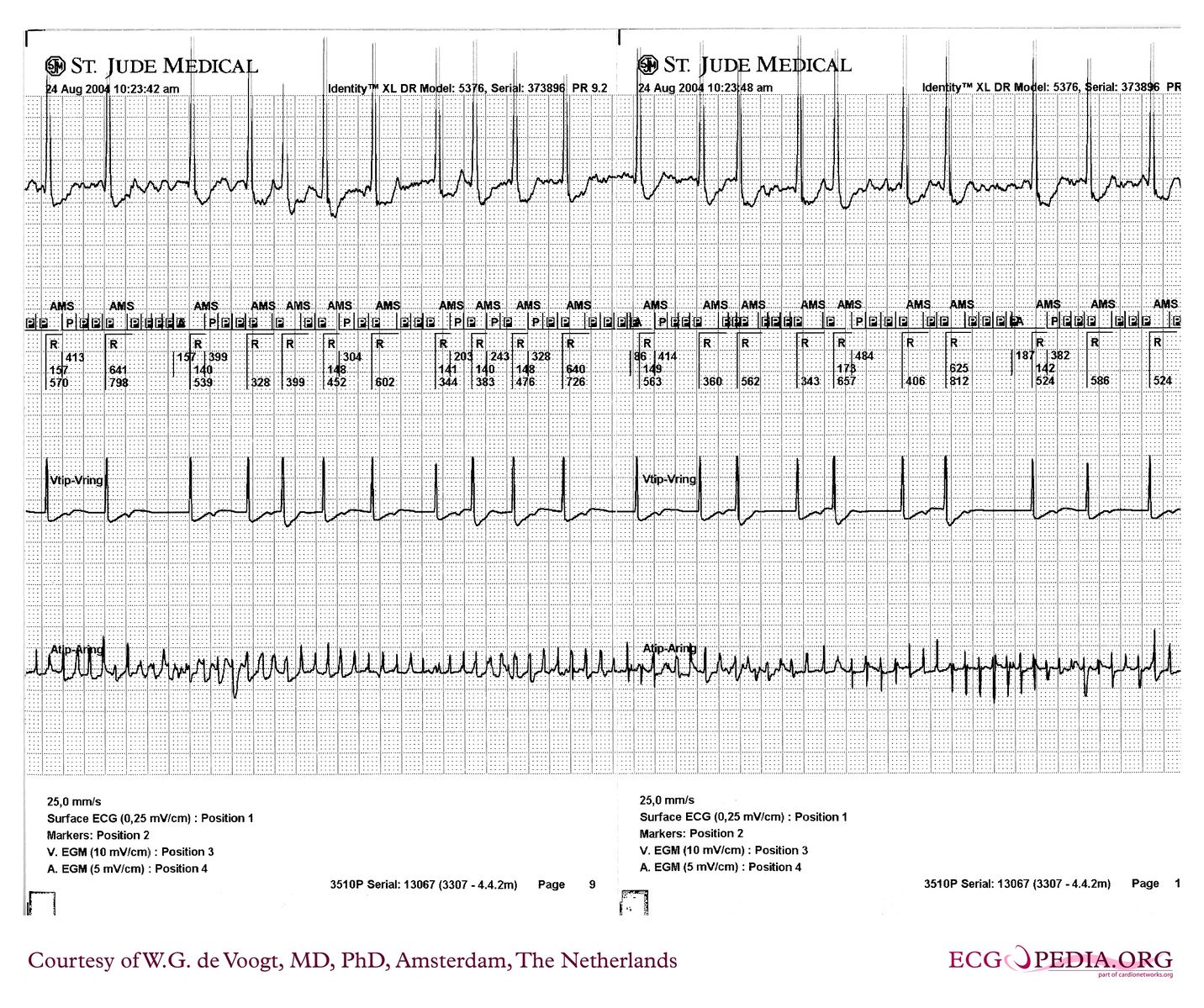 File:DVA1085.jpg - ECGpedia