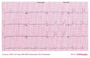 De Voogt ECG Archive - Myocardial Infarction - Anterior - ECGpedia