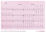 De Voogt ECG Archive - Supraventricular Rhythms - AVNRT - ECGpedia