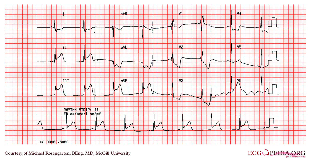 McGill Case 306 - ECGpedia