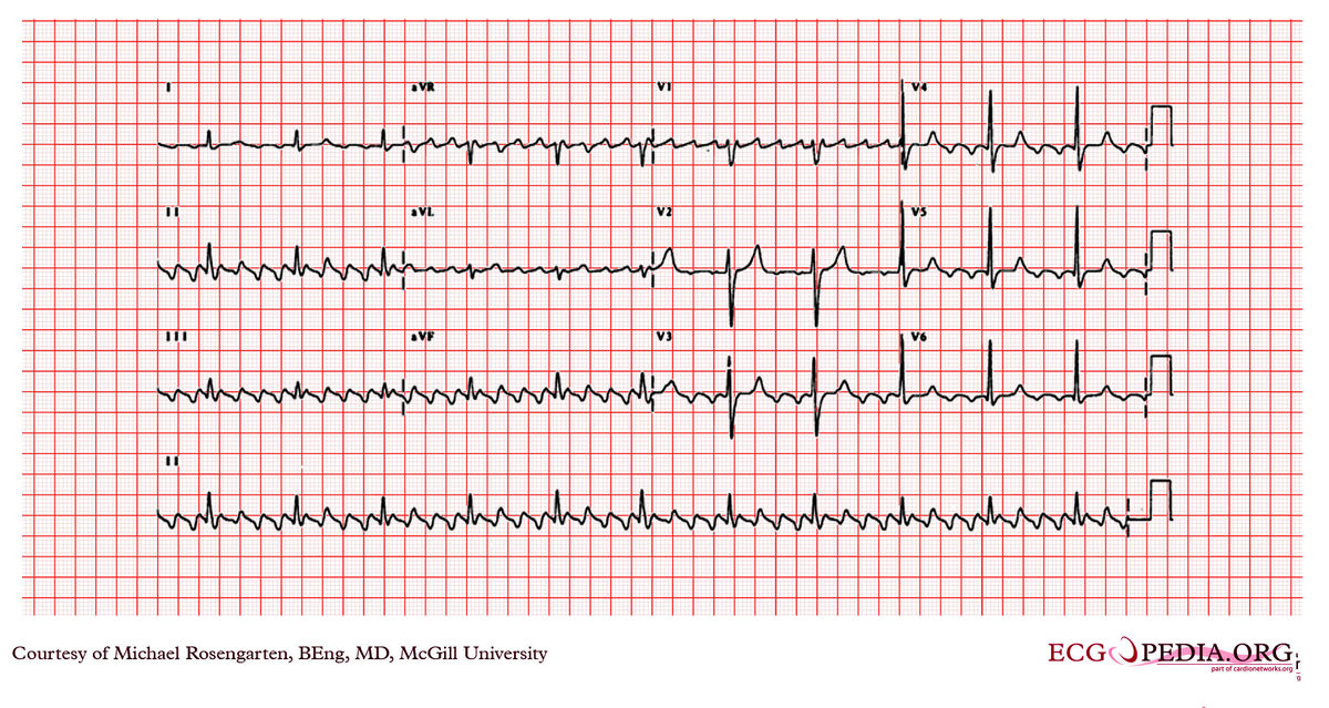 McGill Case 65 - ECGpedia