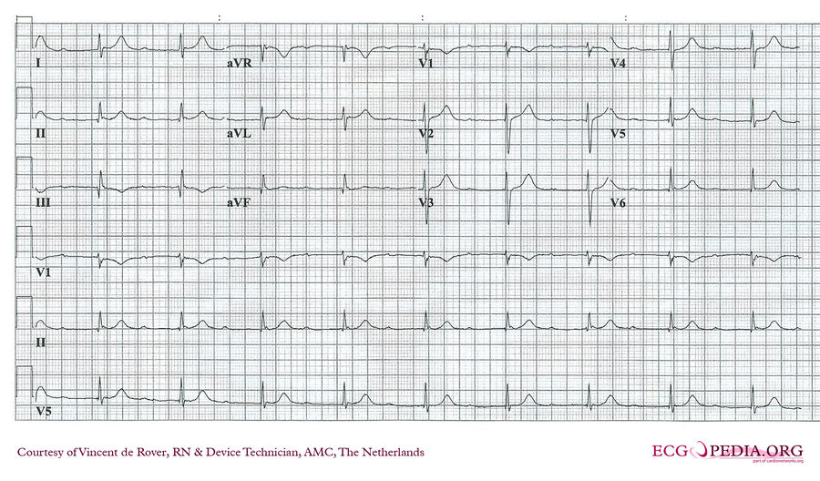 AMC Case 69 - ECGpedia