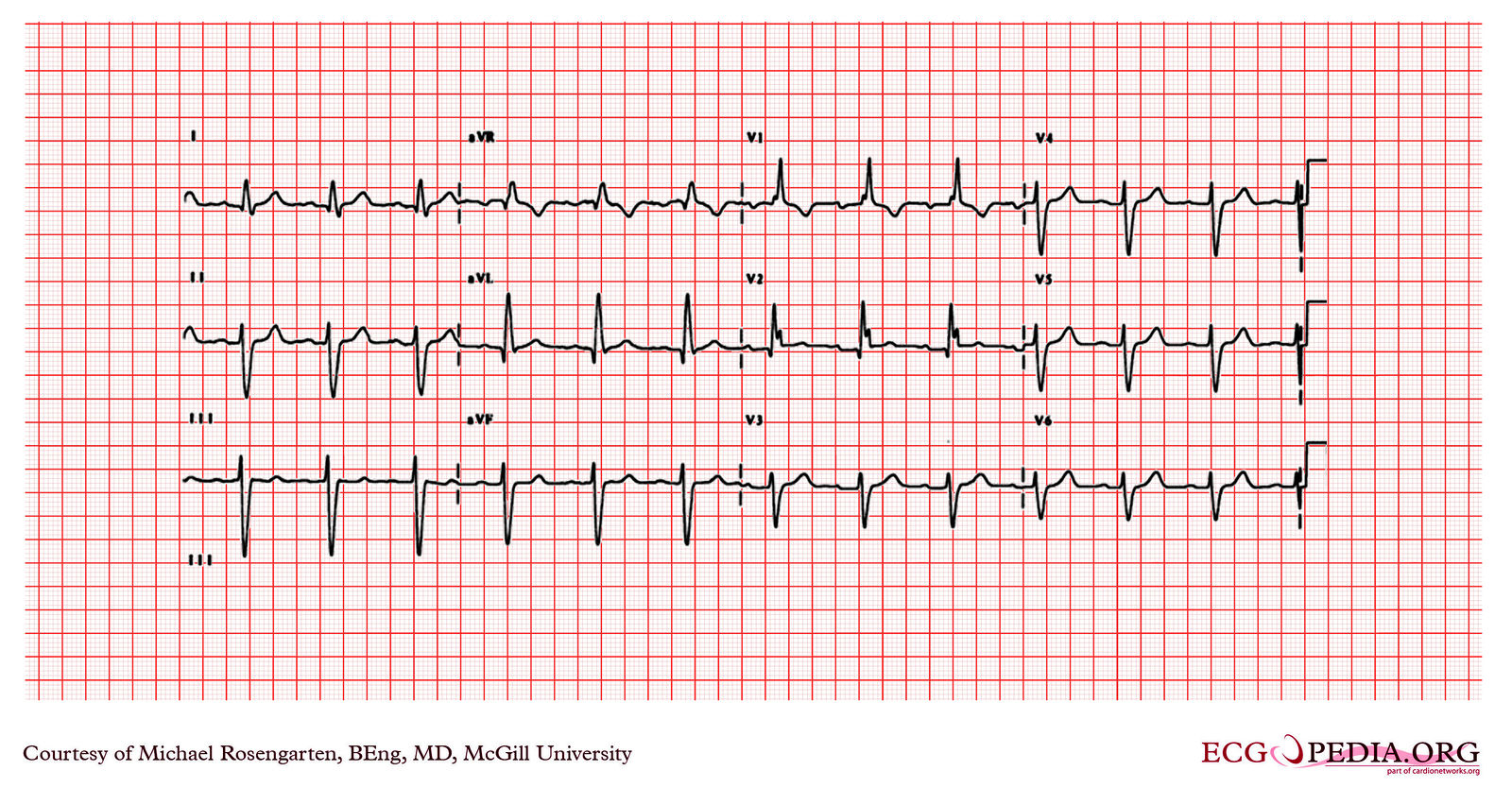 File:E000726.jpg - ECGpedia