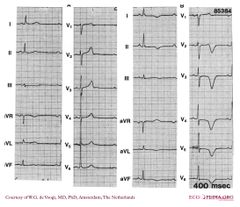 De Voogt ECG Archive - Myocardial Infarction - Anterior - ECGpedia