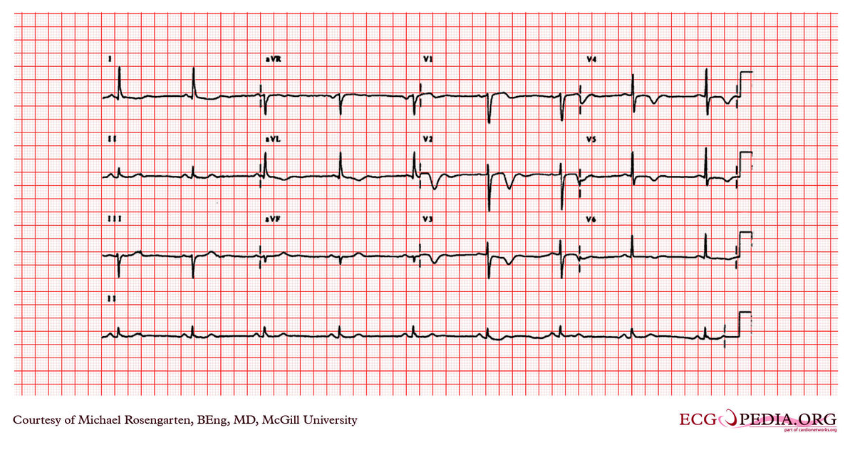 McGill Case 266 - ECGpedia