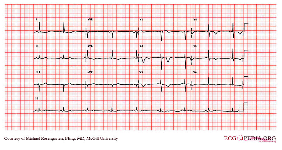 McGill Case 266 - ECGpedia