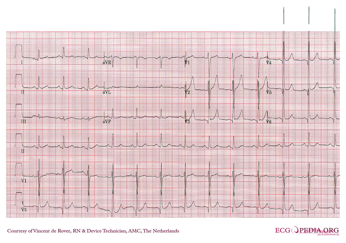 Amc Case 214 Ecgpedia