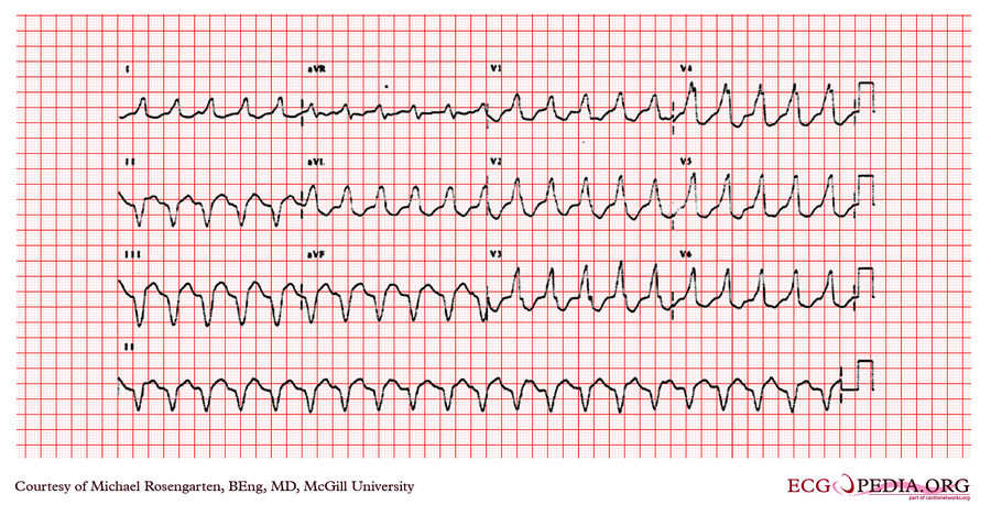 McGill Case 253 - ECGpedia