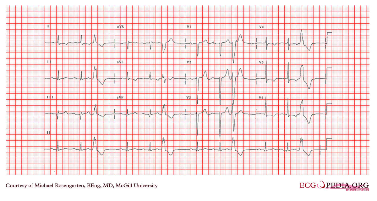 File:E355.jpg - ECGpedia