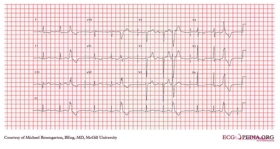 McGill Case 355 - ECGpedia