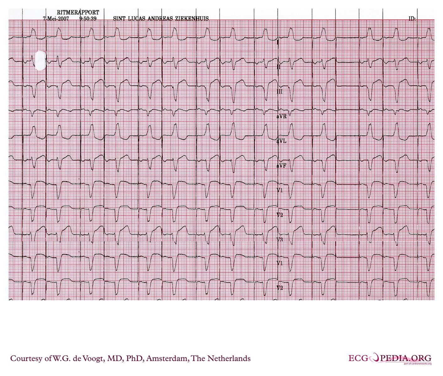 Filedva0920 Ecgpedia