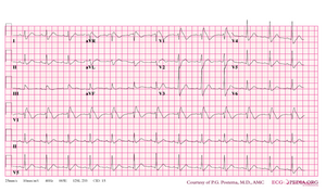 De-Brugada syndrome type1 example5.png