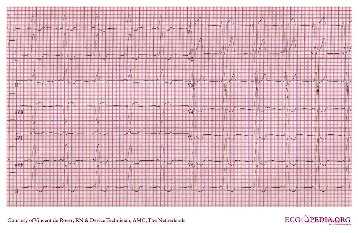 AMC Case 78 - ECGpedia