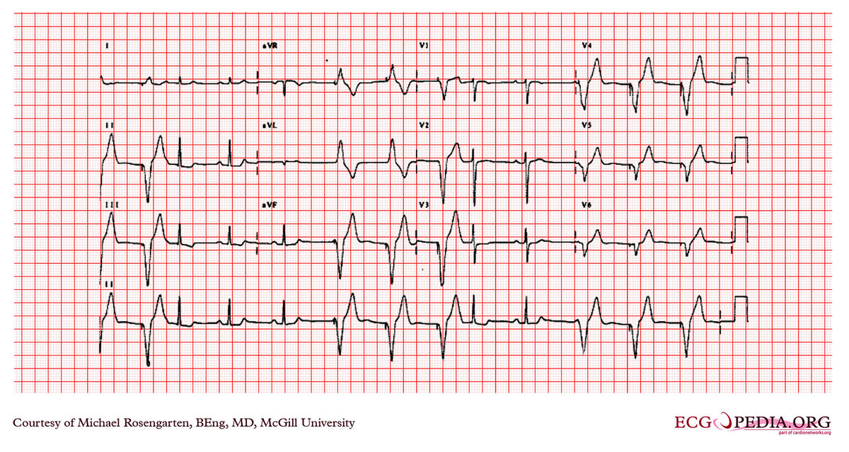 McGill Case 95 - ECGpedia