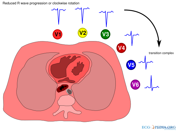 clockwise-and-counterclockwise-rotation-ecgpedia