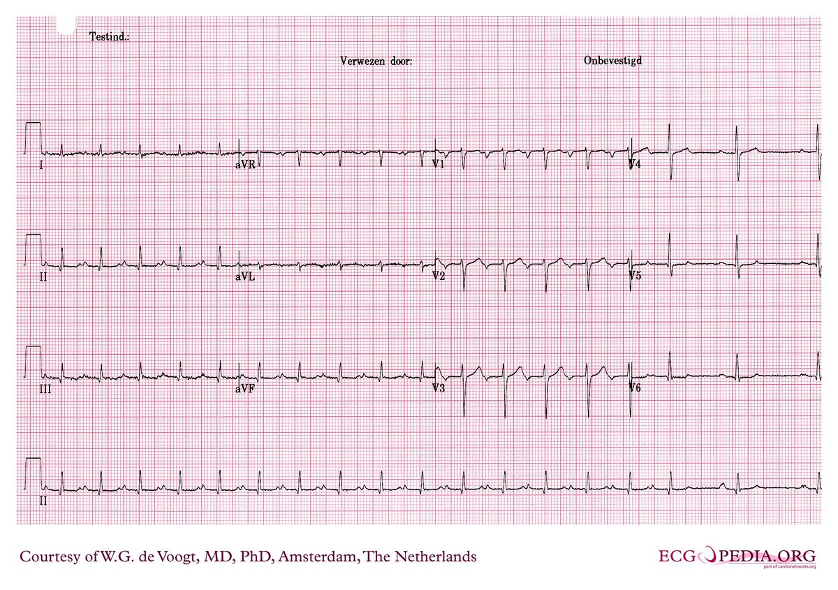 File:dva0264.jpg - Ecgpedia