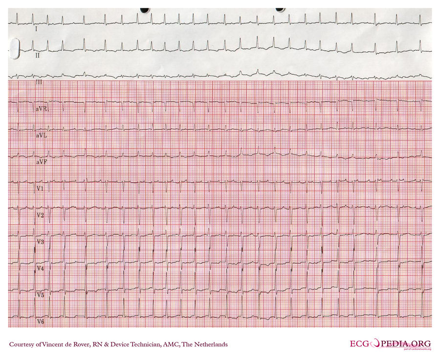 AMC Case 61 - ECGpedia