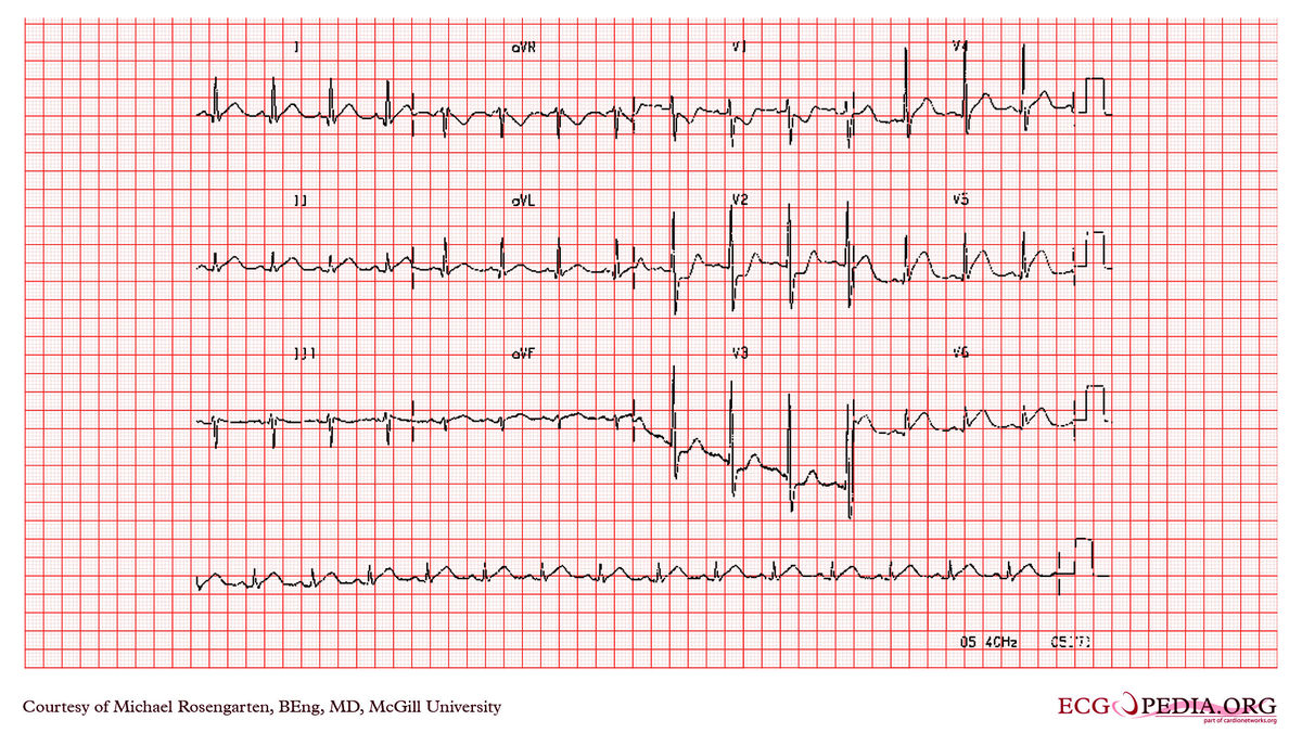 McGill Case 310 - ECGpedia