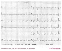 De Voogt ECG Archive - Supraventricular Rhythms - Atrial flutter - ECGpedia