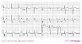 Myocardial infarction post primary PCI in a pacemaker patient