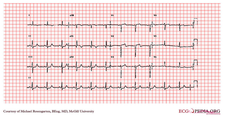 McGill Case 209 - ECGpedia