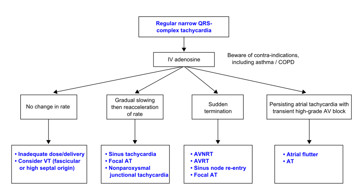 Effect of adenosine - ECGpedia