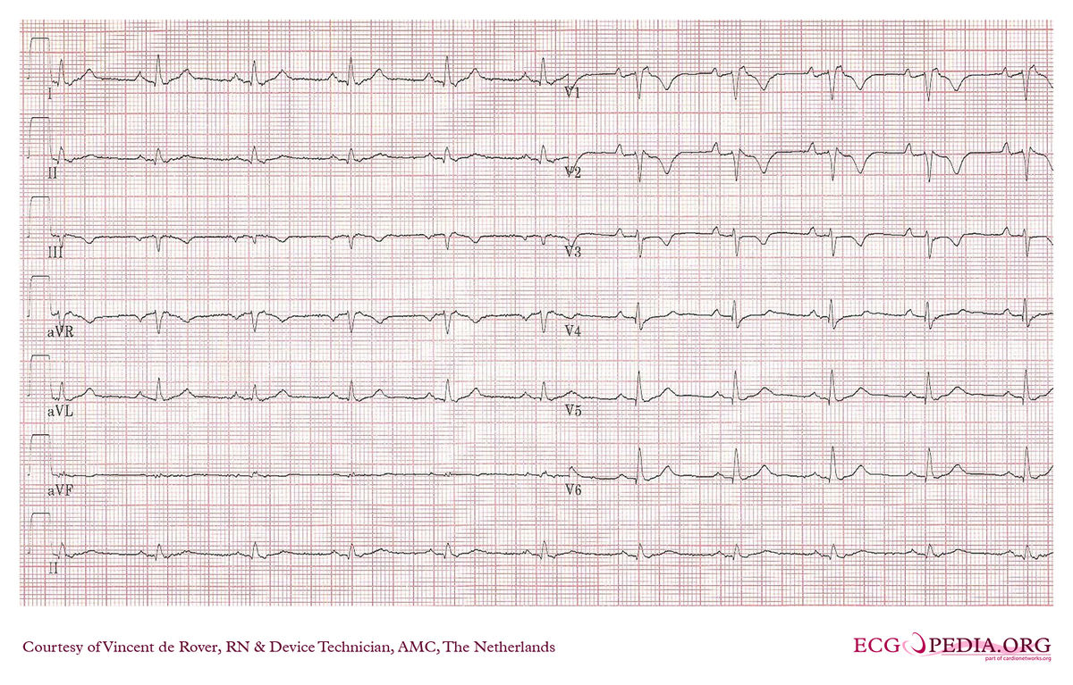 Экг каждому. ЭКГ тесты. Тесты по ЭКГ С ответами для врачей. Vc200 ECG-ЭКГ. Цвета контактов на ЭКГ.