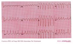 De Voogt ECG Archive - Intraventricular Conduction - ECGpedia