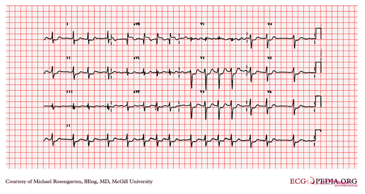 McGill Case 228 - ECGpedia