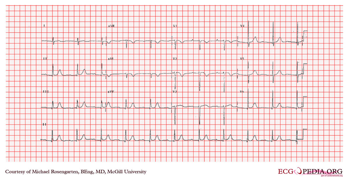 McGill Case 376 - ECGpedia