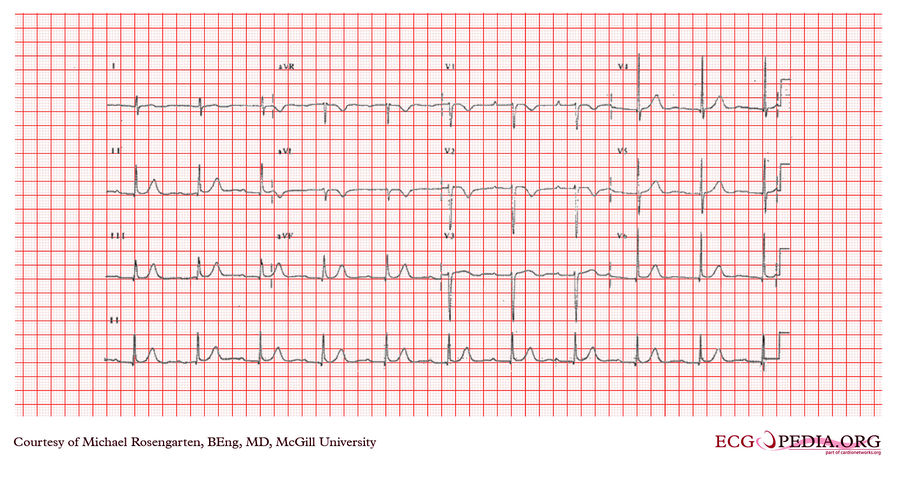 McGill Case 376 - ECGpedia