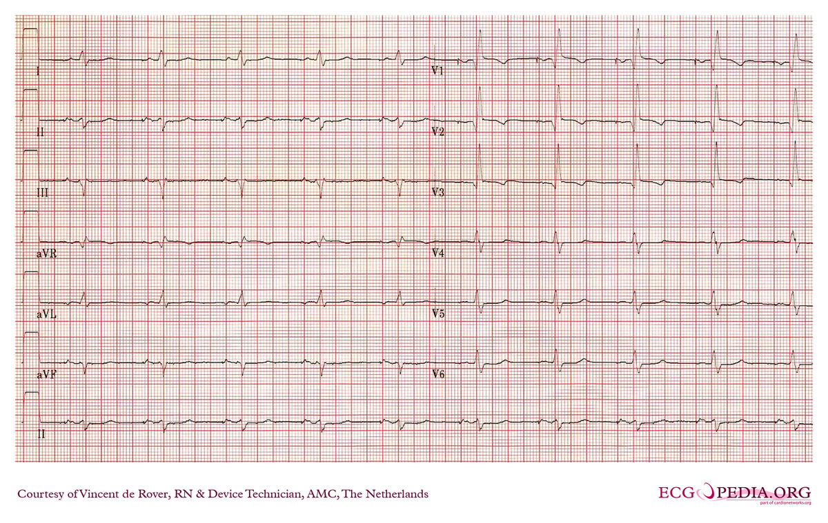 AMC Case 159 - ECGpedia