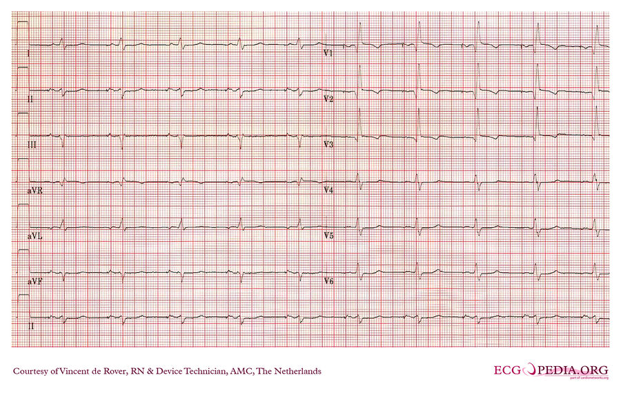 Amc Case 159 - Ecgpedia