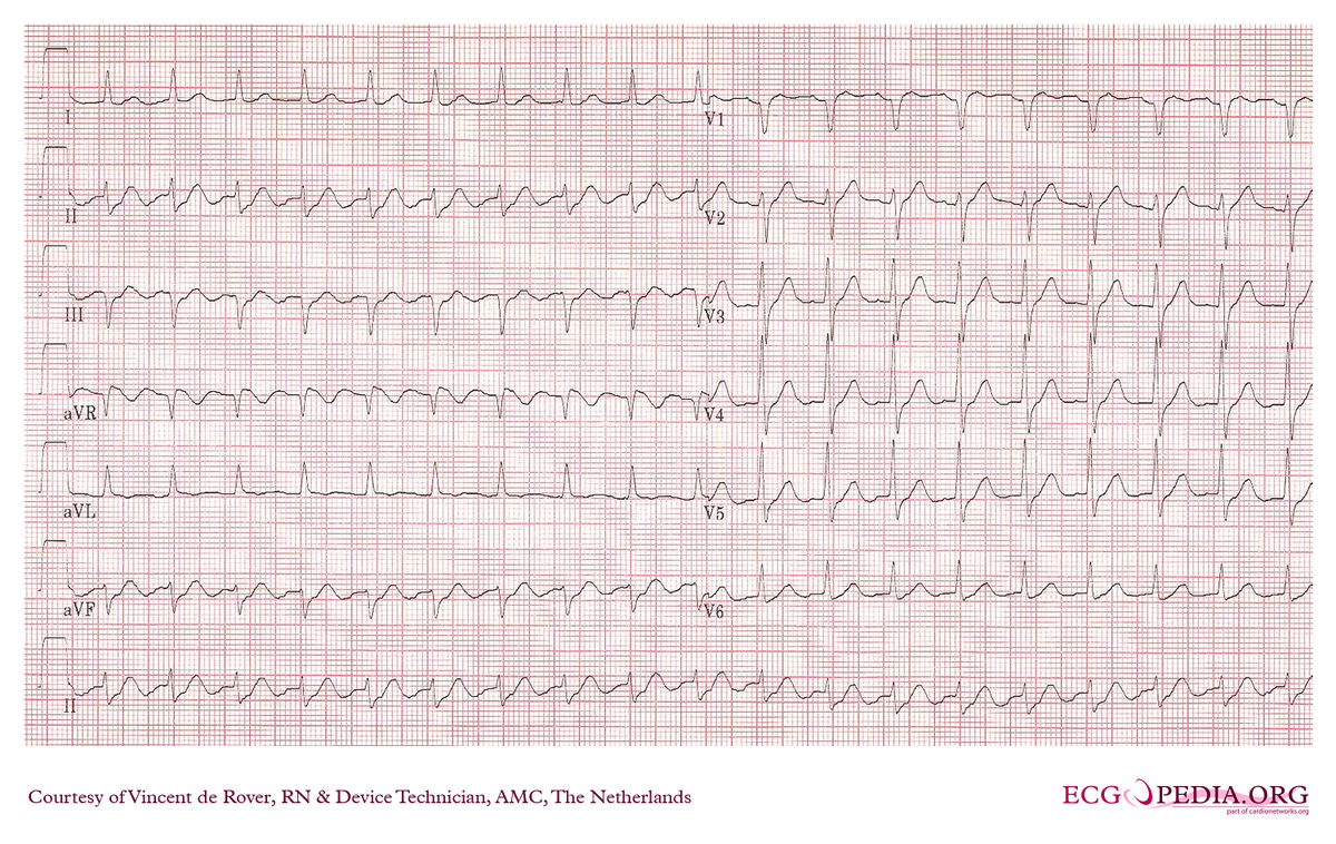 AMC Case 97 - ECGpedia