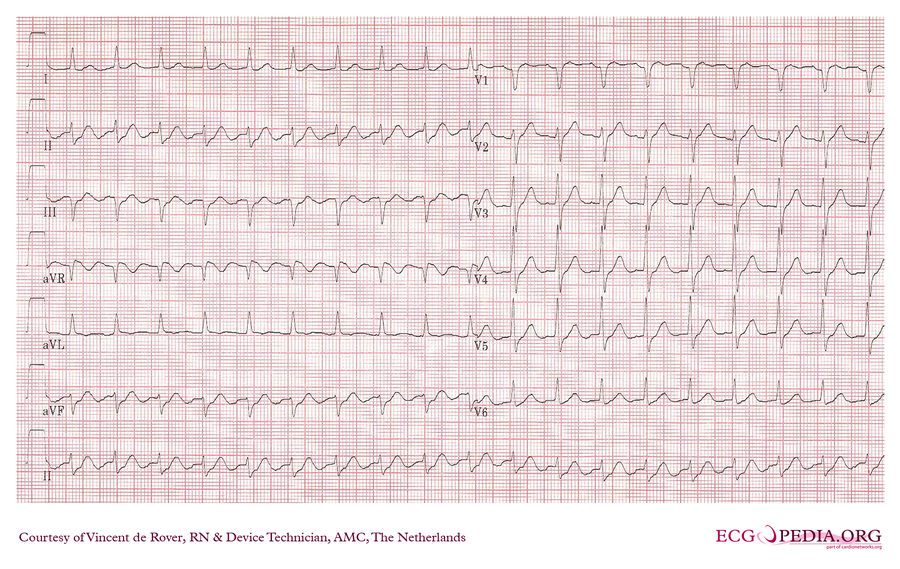 AMC Case 97 - ECGpedia