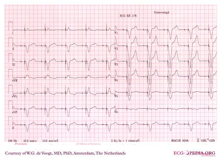 Pacemaker - ECGpedia