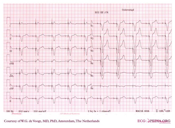 Pacemaker - ECGpedia