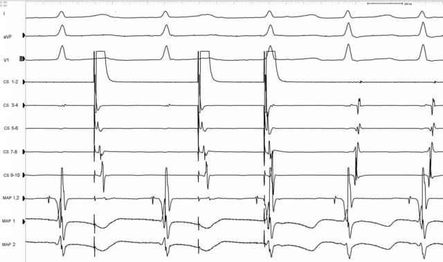 Filepuzzle 2007 6 231 Fig3 Ecgpedia