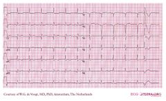 De Voogt ECG Archive - Electrolyte Disorders - ECGpedia