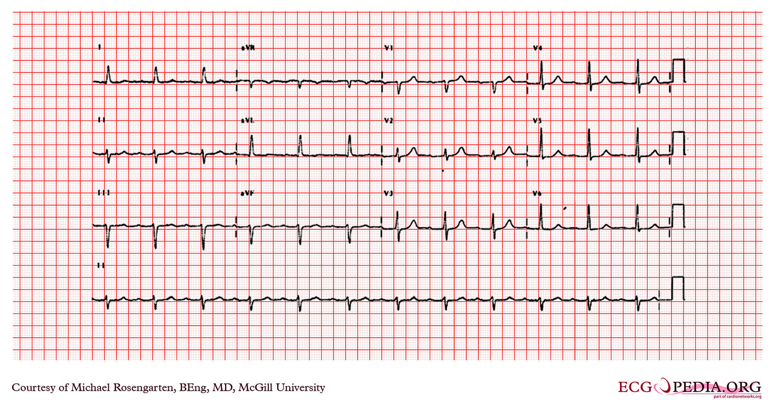 File:E000714.jpg - ECGpedia