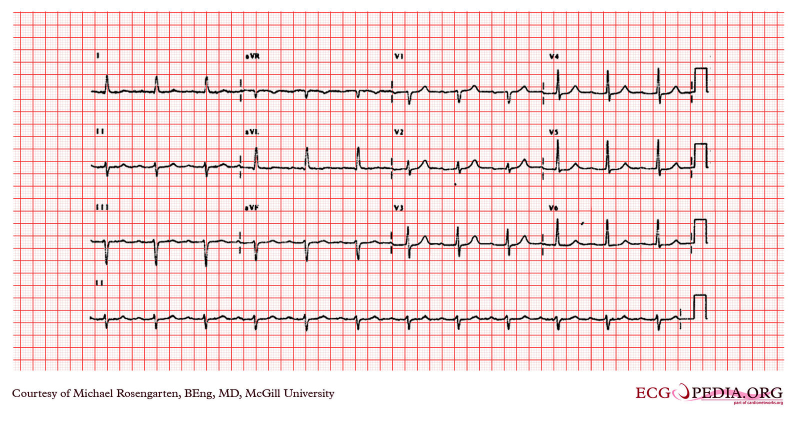 File:E278.jpg - ECGpedia