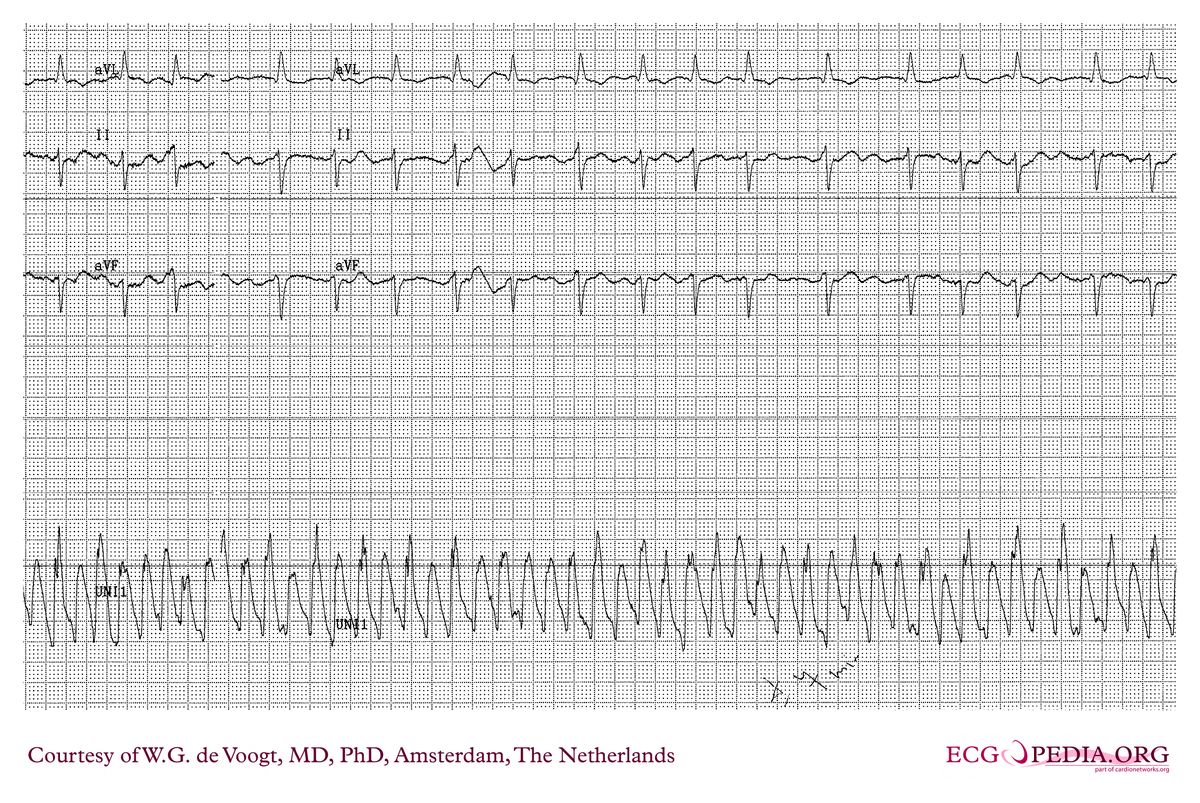 File:DVA0191.jpg - ECGpedia