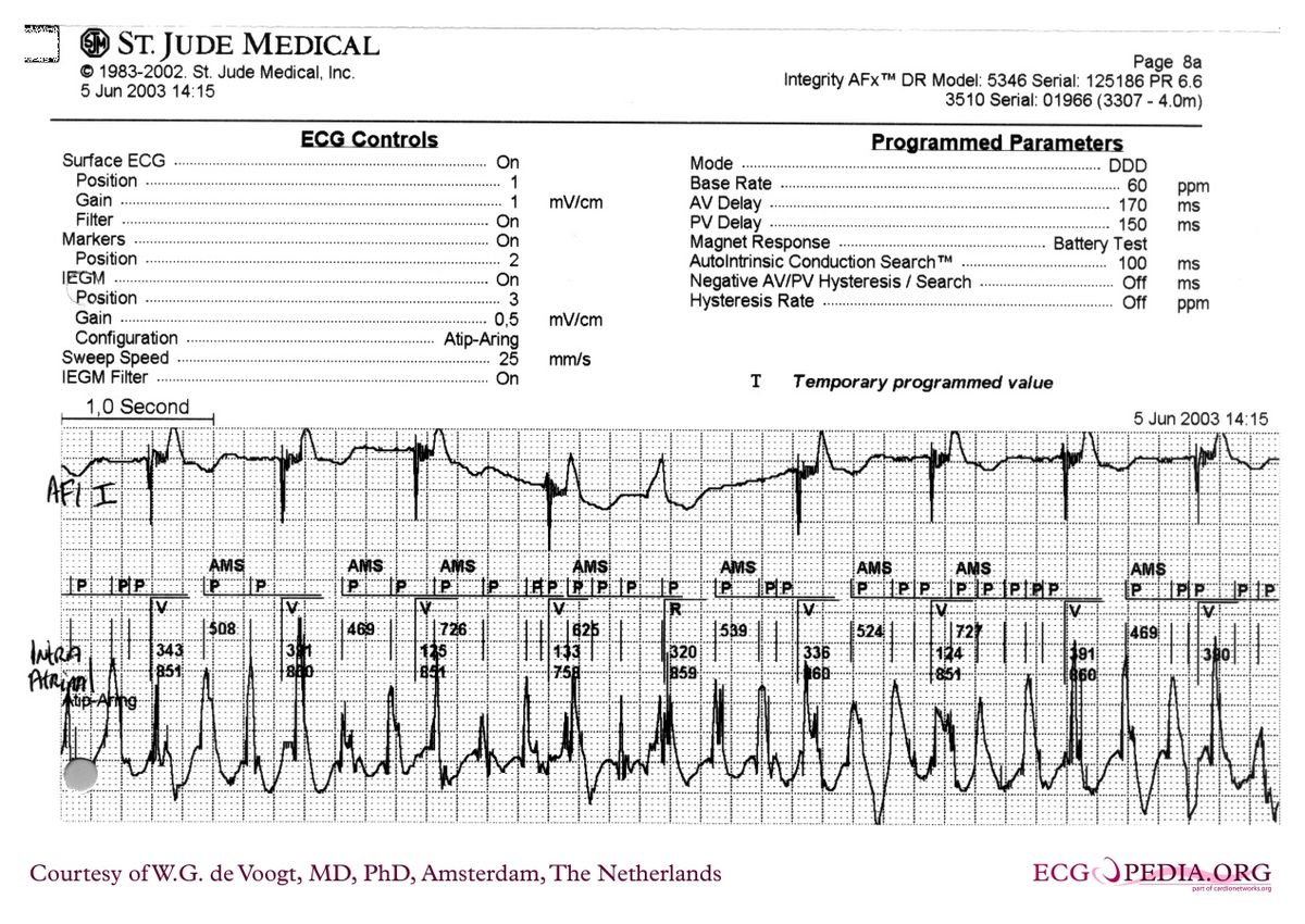 File:DVA0991.jpg - ECGpedia