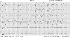 Cases and Examples - ECGpedia