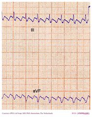 De Voogt ECG Archive - Supraventricular Rhythms - Atrial flutter - ECGpedia