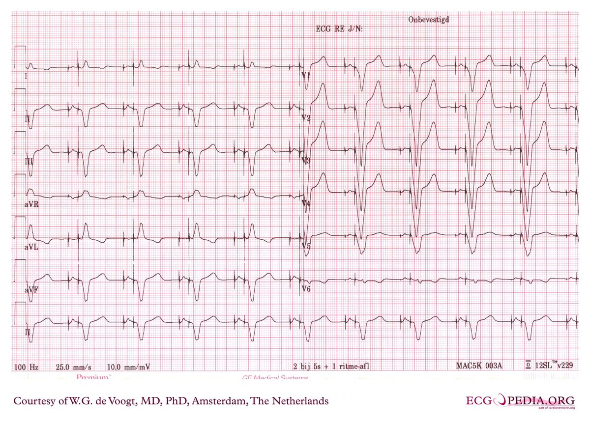 File:dva0939.jpg - Ecgpedia