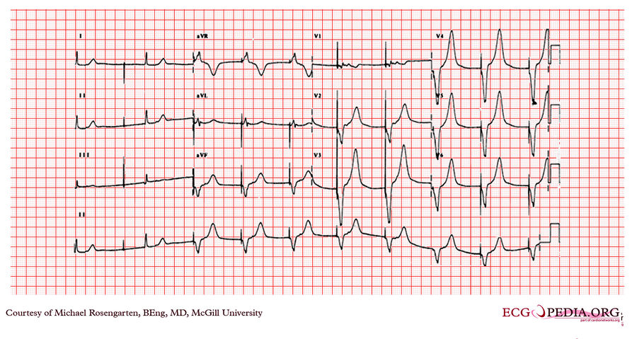 McGill Case 67 - ECGpedia