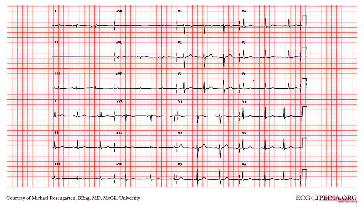 McGill Case 279 - ECGpedia