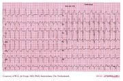 De Voogt Ecg Archive - Supraventricular Rhythms - Af - Ecgpedia