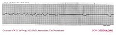 De Voogt ECG Archive - Supraventricular Rhythms - SSS - ECGpedia
